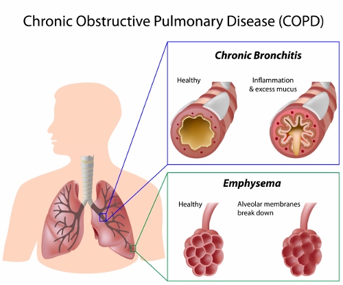 Broncopneumopatia cronica ostruttiva BPCO