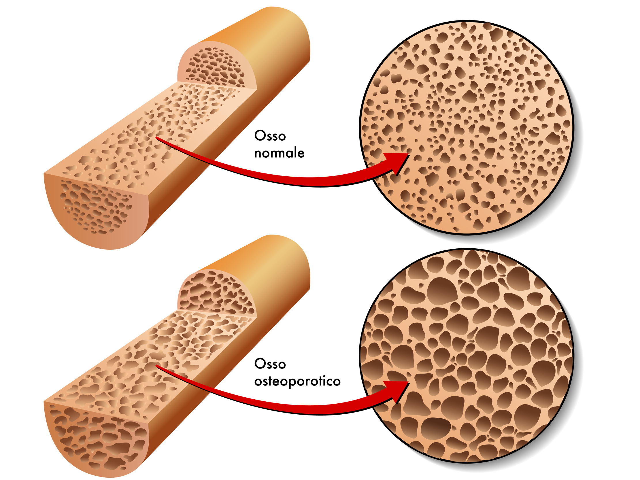 Osteoporosi causata da farmaci • NCF