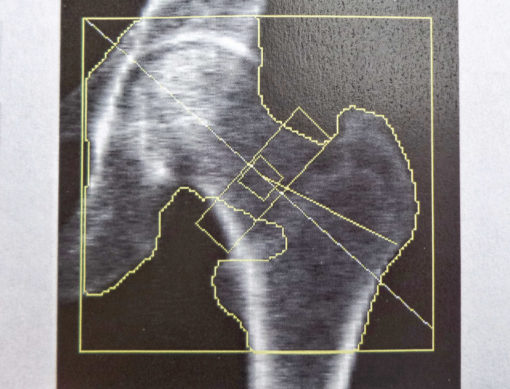 La densimetria ossea è un esame utile per valutare la presenza anche di osteoporosi secondarie