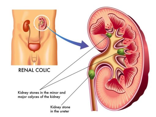 La calcolosi è solitamente asintomatica quando i calcoli renali restano localizzati nel rene. Quando invece passano nell'uretere causano spesso una colica