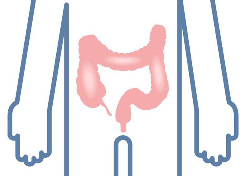 La colite ulcerosa è una malattia infiammatoria cronica intestinale (MICI) che si limita al colon caratterizzata da manifestazioni spesso improvvise