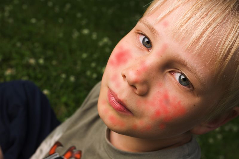 Dupilumab per la dermatite atopica grave nei bambini